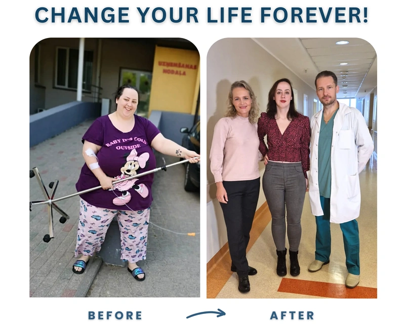 Before and after gastric bypass